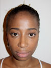 Nose Job NYC