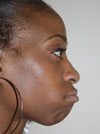 Nose Job NYC