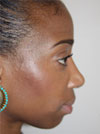 Nose Job NYC