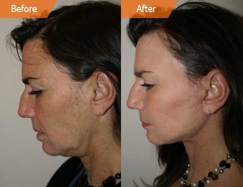 Female Before and After Laser Resurfacing