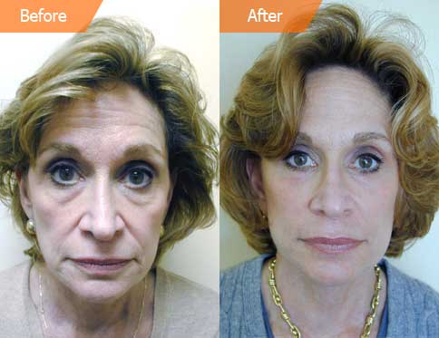 Woman's face, before and after Mini Facelift treatment, front view, patient 1
