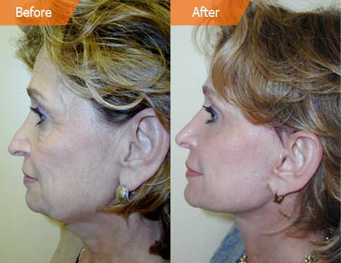 Woman's face, before and after Mini Facelift treatment, l-side view, patient 1