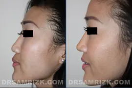 23 year old Asian patient wanted to add definition to her face by undergoing a rhinoplasty. Dr. Rizk performed the rhinoplasty with auricular graft to give her more definition. The auricular graft was necessary as the patient’s own septum was too thin for creating sufficient definition in her nose. The set of pictures is shown one year after her procedure.