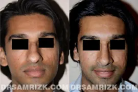 25 yo female wishes to improve drooping nasal tip, bump and bulbous nasal tip. Patient underwent open rhinoplasty with tip support with her own septum cartilage to achieve a better long term result of tip support. Tip was also refined with cartilage reduction and suture techniques, and bump was removed naturally. Patient is shown 1 year after nose surgery.
