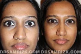 25 year old Indian/middle eastern patient with typical ethnic rhinoplasty characteristics of thick tip skin, wide nostrils, drooping nasal tip and weak tip support.