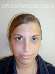 photo Female after Chin Surgery