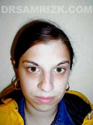 photo Female before Chin Surgery