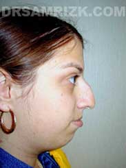 Female before Chin Surgery - side view