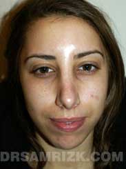 Female after Chin Surgery
