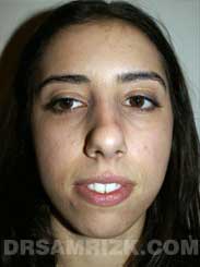 Female before Chin Surgery