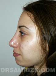 Female after Nose Surgery and Chin Implant - side view