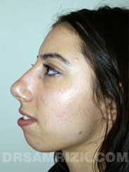 Female before Nose Surgery and Chin Implant - side view