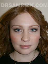 Female after Neck and Chin Surgery