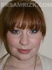 Female before Neck and Chin Surgery