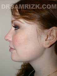 Female after Neck and Chin Surgery - side view