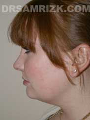 Female before Neck and Chin Surgery - side view