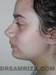 Female after Neck Surgery and Chin Implant - side view