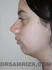 Female before Neck Surgery and Chin Implant - side view