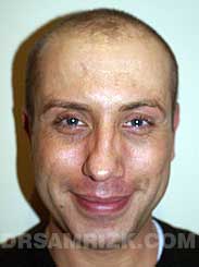 Ear Surgery after photo male patient