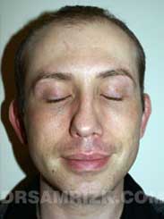 Male patient before Ear Surgery - pic