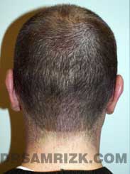 Ear Surgery after image male