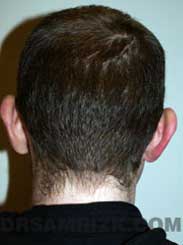 Ear Surgery before image male