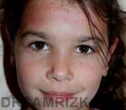 photo patient after Otoplasty