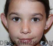 photo patient before Otoplasty