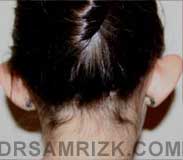 pic patient before Otoplasty