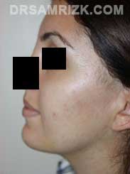 Female patient after Chin Implant - image