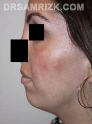 Female patient before Chin Implant - image