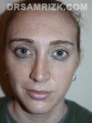 Chin Implant surgery after photo Female