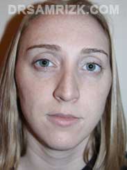Nose Surgery and Chin Implant photo