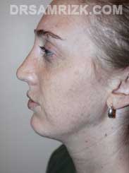 Female patient after Chin Implant - pic
