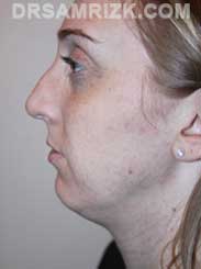Female patient before Chin Implant - pic
