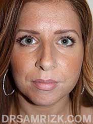 Female patient before Nose Surgery and Chin Implant - front view