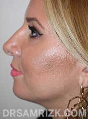 Female patient after Nose Surgery and Chin Implant - side view