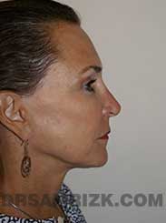 photo Female after Eyelid Surgery