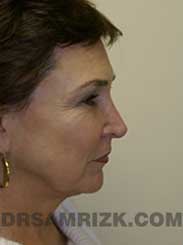 photo Female before eyelid surgery
