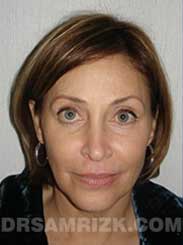 Female before Eyelid Surgery - photo