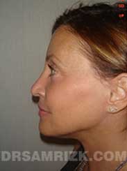 image Female after Eyelid Surgery - side view
