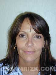 image Female after Eyelid Surgery - frontal view