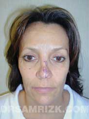 image Female before Eyelid Surgery - frontal view