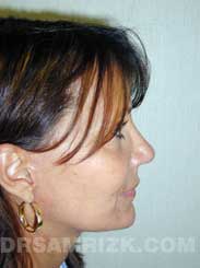 image female patient after eyelift surgery
