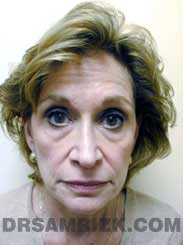 image Female before Eyelid Surgery