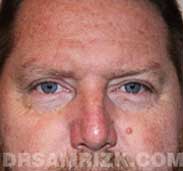 male blepharoplasty after - front view