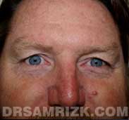 male blepharoplasty before - front view