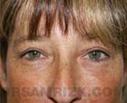 eyelid surgery after pictures
