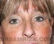 eyelid surgery before after photo