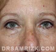 female photo after eyelid surgery